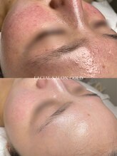 ゴールド 恵比寿店(GOLD)/施術５回＋肌質改善スキンケア