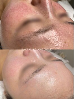 ゴールド 恵比寿店(GOLD)/施術5回+肌質改善スキンケア