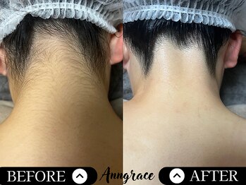 アングレイス(Anngrace)/【お顔脱毛うなじ】Before/After