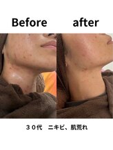 ギンザ リボーン(Ginza Reborn)/ニキビ肌