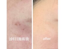 ルミラポー(Lumira Peau)/シミ集中ケア