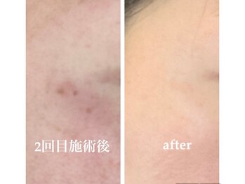 ルミラポー(Lumira Peau)/シミ集中ケア