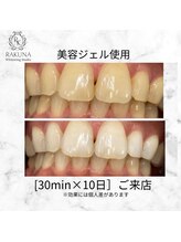ラクナ ホワイトニング(RAKUNA)/プロプラークホワイトニング症例