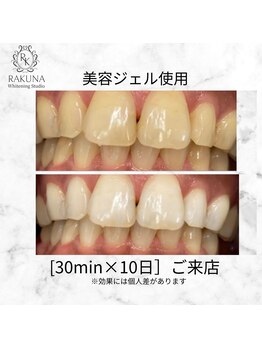 ラクナ ホワイトニング(RAKUNA)/プロプラークホワイトニング症例