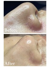 ジェンヌ(jenne.)/毛穴エクストラクション