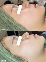 ちらちゅら/クリスティーナ【施術1回】経過