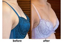 エミニナル(EMININAL)/30代バストケア（５回目）