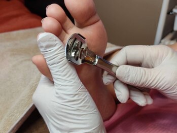 ドクターネイル爪革命ふわらの写真/【東広島西条/無料P完備】自己流ケアはもう卒業！繰り返す「魚の目・タコ」をプロによる施術で根本から改善