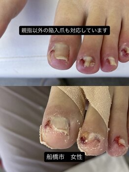 巻き爪じゅん 船橋店/親指以外の陥入爪も改善へ