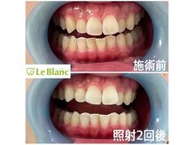 ルブラン 奈良店(Le Blanc)/口腔内清潔に。。。