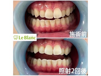 ルブラン 奈良店(Le Blanc)/口腔内清潔に。。。