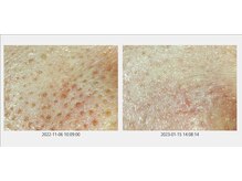 サロン ド ボーテ プルーラ(Salon de beaute PLURA)/毛穴詰まりもスッキリ