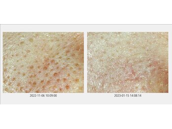 サロン ド ボーテ プルーラ(Salon de beaute PLURA)/毛穴詰まりもスッキリ