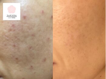 サクラ 伊勢原店(SAKURA)/大人のシミケア