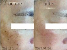 ブランシェ 金沢店 × 椿/シミケア　『50代お客様』