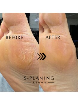 リノア(Linoa)/韓国式足裏角質ケア-splaning-