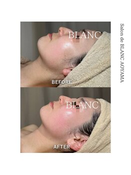 サロン ド ブラン アオヤマ(Salon de BLANC AOYAMA)/1番人気コース!before/after