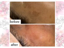 アリュメント(Allument)/【Before After】シミケア