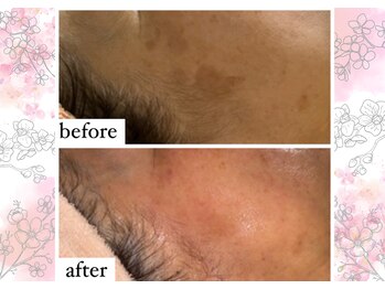 アリュメント(Allument)/【Before After】シミケア