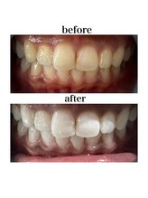 ホワイトニングショップ 三島店(WHITENING SHOP)/5回券終了後のbefore・after♪