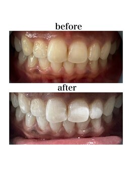 ホワイトニングショップ 三島店(WHITENING SHOP)/5回券終了後のbefore・after♪