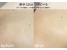 韓国ピーリング/水光肌【毛穴・ざらつき・黒ずみ】お背中LHAララピール¥9,800