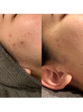 ラノン(LANON)/ビフォーアフター15