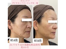 パス アイ(PATH eye)の雰囲気(ダイヤモンドピーリングで角質除去、ポレーションでハリ感アップ)