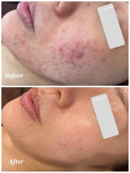 ファシル(Facile)/肌質改善ケア