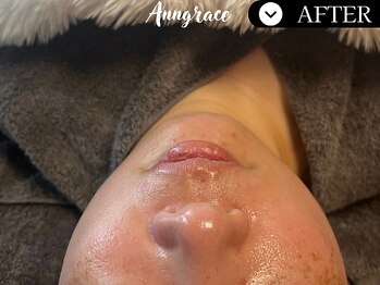 アングレイス(Anngrace)/ 【人気No.3】小顔フェイシャル