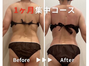 エピデリ 福岡大濠(EPI de RIZ)/【痩身/ダイエット】1ヶ月集中