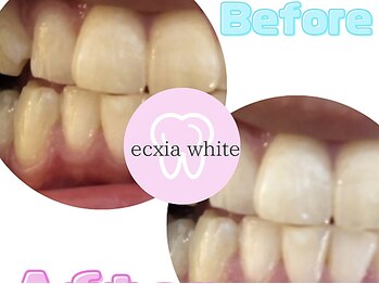 エクシアホワイトニング 姫路店/歯のビフォーアフター