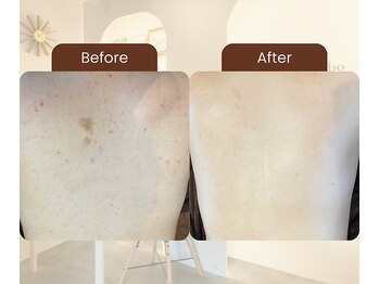 エヌエースキン たまプラーザ店(NAskin)の写真/式当日の素肌に自信を。肌診断に基づき、貴方にあったハーブピーリングでニキビ・毛穴悩みをで根本改善◎