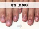 男性(自爪風)