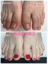 フット深爪矯正
