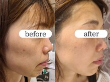 ブラン(BLANC)/【芸能人ピーリング】水光ピール