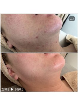 グレーシス(Graces)/繰り返すニキビBeforeAfter