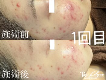 リリアック(Re:Lilyac)/Re:ilyac#ハーブピーリング