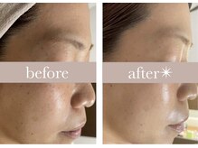 エバーグリーン(Evergreen)/ハーブピーリング6回の変化