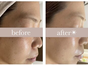 エバーグリーン(Evergreen)/ハーブピーリング6回の変化