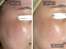 アムールサロン(Amour salon)/光フェイシャルでシミケア/新宿