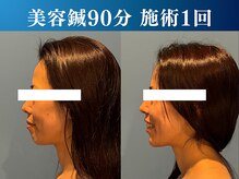 シンク 表参道(CINQ)/フェイスラインスッキリ