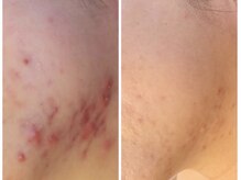 ファブ 青葉店/光フェイシャル