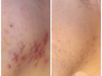 ファブ 青葉店/光フェイシャル