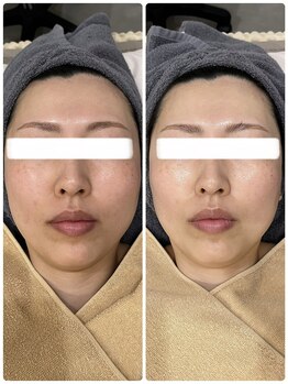 イル 名取店(iru)/糸式リフトアップフェイシャル