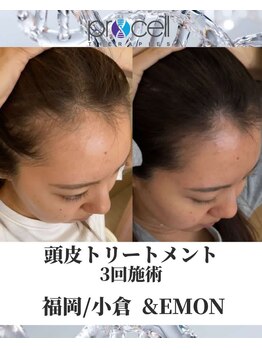 アンドエモン(&EMON)/【頭皮】プロセル効果