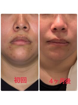 小林整骨院 本町/【肌質改善美容鍼】