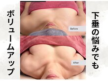 ボニービューティー(Bony Beauty)/BeforeAfter【1】