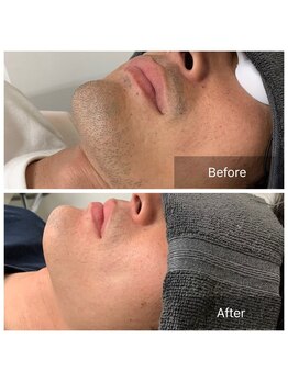 脱毛サロン メンズ 堂々/脱毛ビフォーアフター