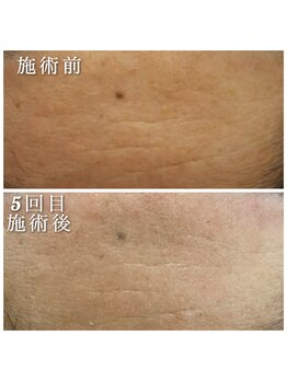 ヴィオナス(Veonus)/額の肌変化